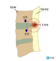 추간판탈출증수술2