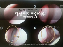 코물혹수술5
