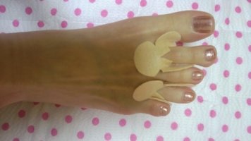 발가락사이무좀1