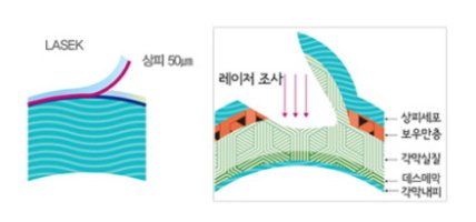 라식라섹부작용6