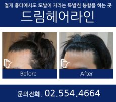 머리카락이식수술2