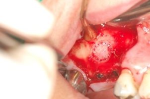 골이식임플란트4