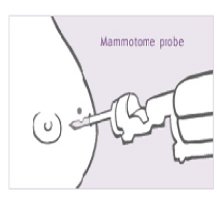 맘모톰수술병원1