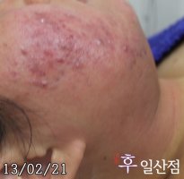 일산여드름압출2