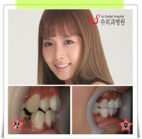 연예인라미네이트2