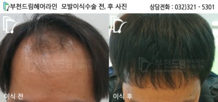 인천모발이식2
