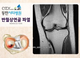 반월상연골파열1