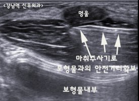 거대섬유선종2