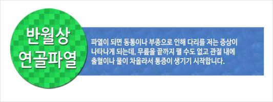 반월상연골파열3