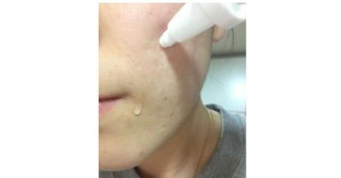 여드름자국치료4