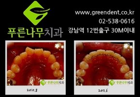 부분치아교정1