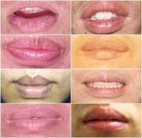 입술축소수술4