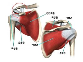 어깨인대파열6