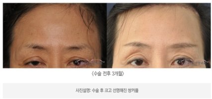 눈썹거상술1