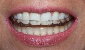 이갈이스플린트4