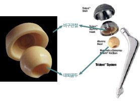 인공고관절1