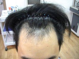 청주모발이식5