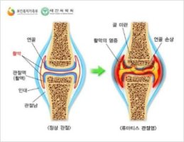 류마티스관절염초기증상5