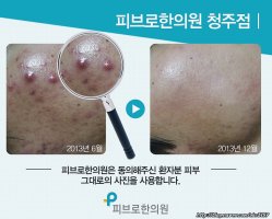 여드름피부과비용2