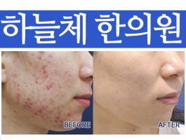 강남여드름한의원4