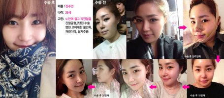 v라인성형비용2