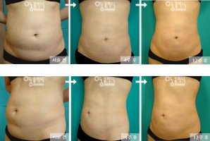 배지방흡입수술6