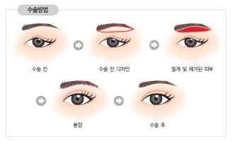 눈썹거상술4