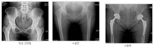 고관절치환술1