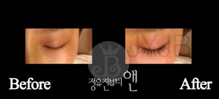 속눈썹증모술4