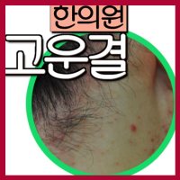 지루성피부염연고2