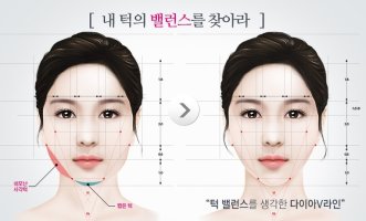 v라인수술2