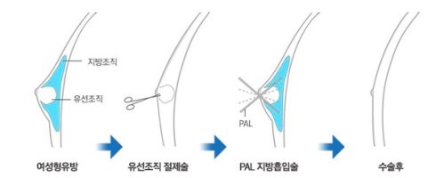 여유증수술추천5