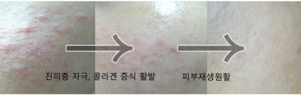 모자이크레이저3