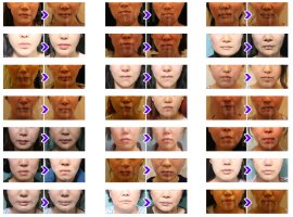 얼굴지방흡입방법4