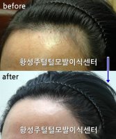 여성헤어라인추천1