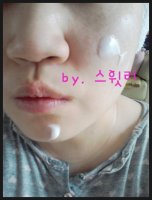 아토피증상사진2