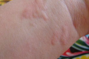 콜린성두드러기2