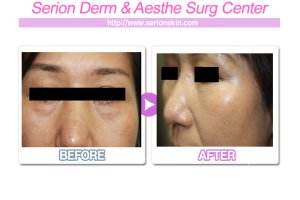 다크써클수술가격1