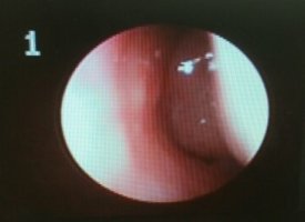 아데노이드수술1