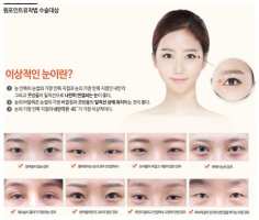 눈두덩이지방제거비용3