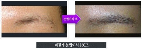 눈썹이식비용1