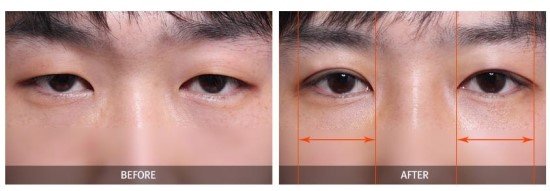 남자성형전후사진1