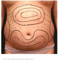 배지방흡입수술1