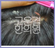 지루성피부염연고4