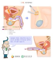 비뇨기과정관수술5