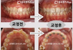 부분치아교정6