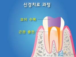 신경치료마취2