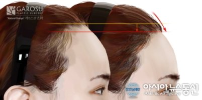 이마헤어라인성형3